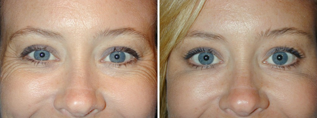 botox-crows-feet-pre-and-post